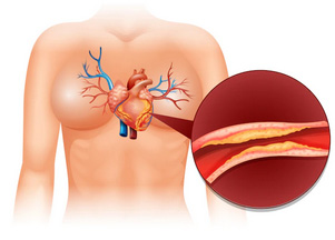 DISLIPIDEMIA